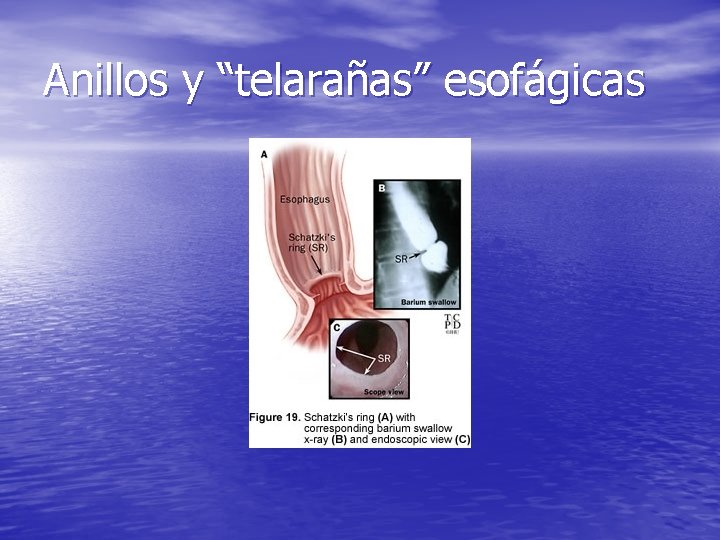 Anillos y “telarañas” esofágicas Anillos y “telarañas” esofágicas
