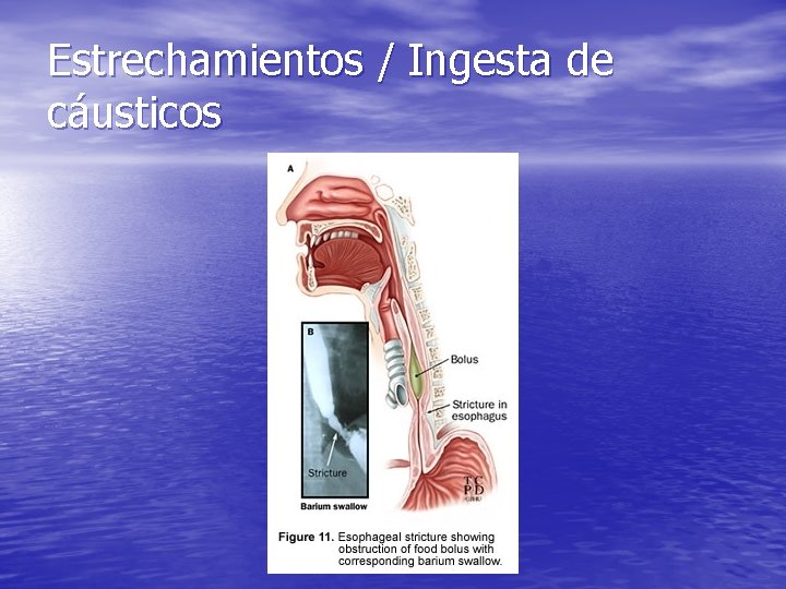 Estrechamientos / Ingesta de cáusticos Estrechamientos / Ingesta de cáusticos