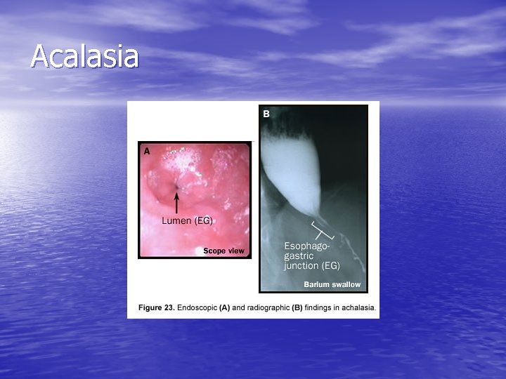 Acalasia Acalasia