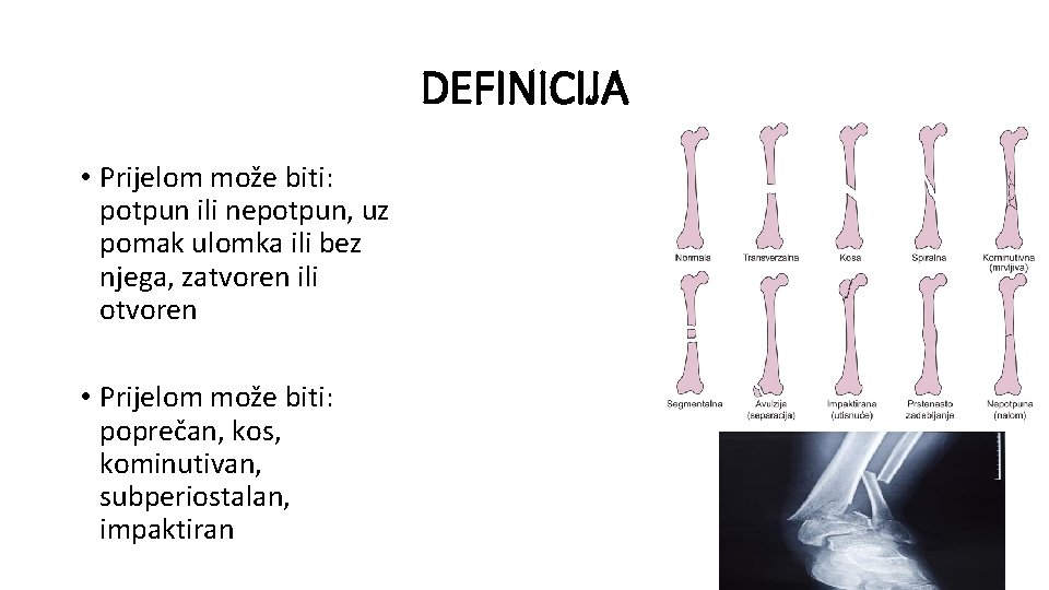 DEFINICIJA • Prijelom može biti: potpun ili nepotpun, uz pomak ulomka ili bez njega,