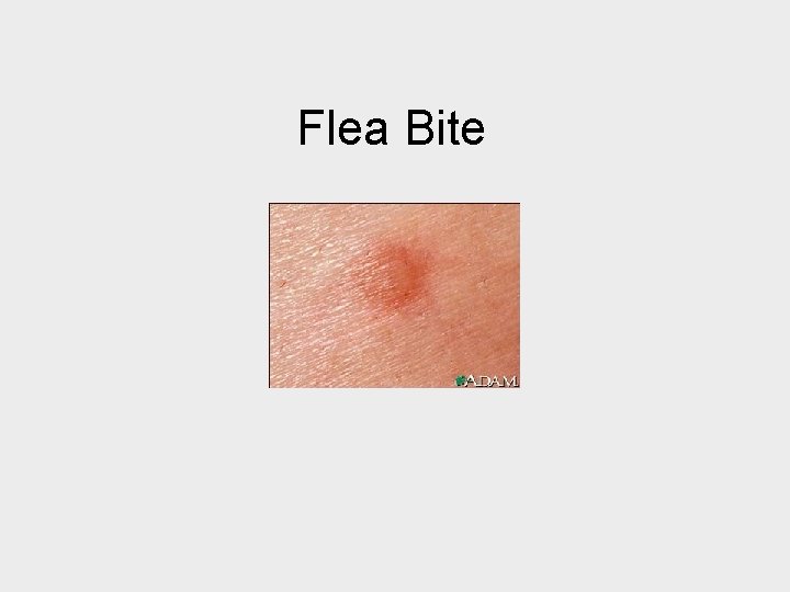 Flea Bite 