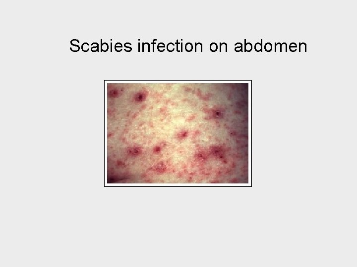 Scabies infection on abdomen 