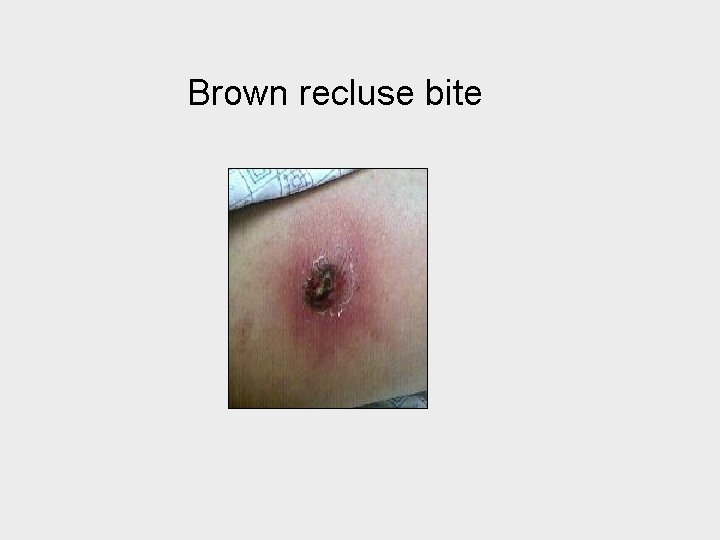 Brown recluse bite 