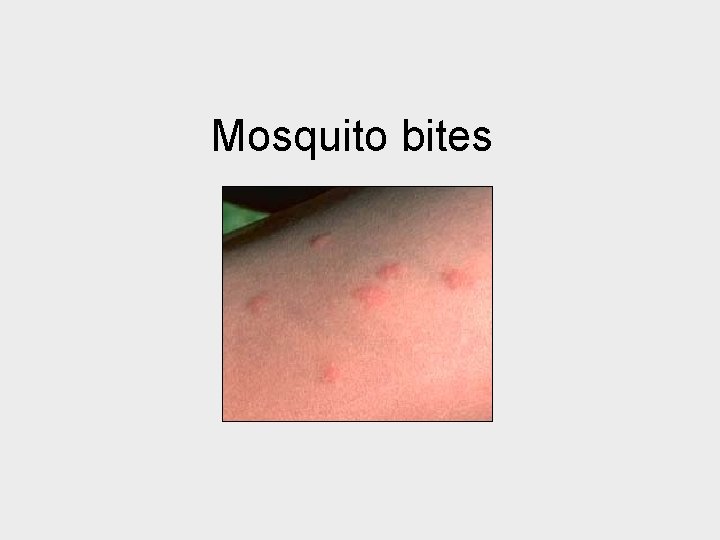 Mosquito bites 
