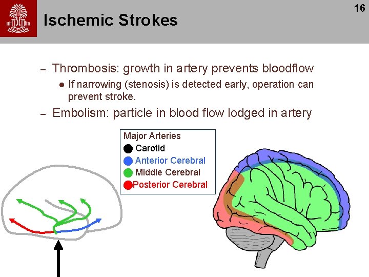 Ischemic Strokes – Thrombosis: growth in artery prevents bloodflow l – If narrowing (stenosis)