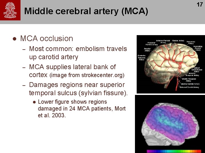 Middle cerebral artery (MCA) l MCA occlusion – – – Most common: embolism travels