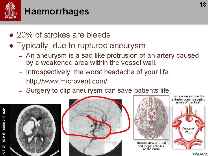 Haemorrhages l l 20% of strokes are bleeds Typically, due to ruptured aneurysm –