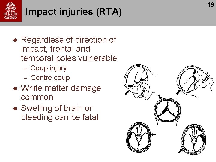 Impact injuries (RTA) l Regardless of direction of impact, frontal and temporal poles vulnerable