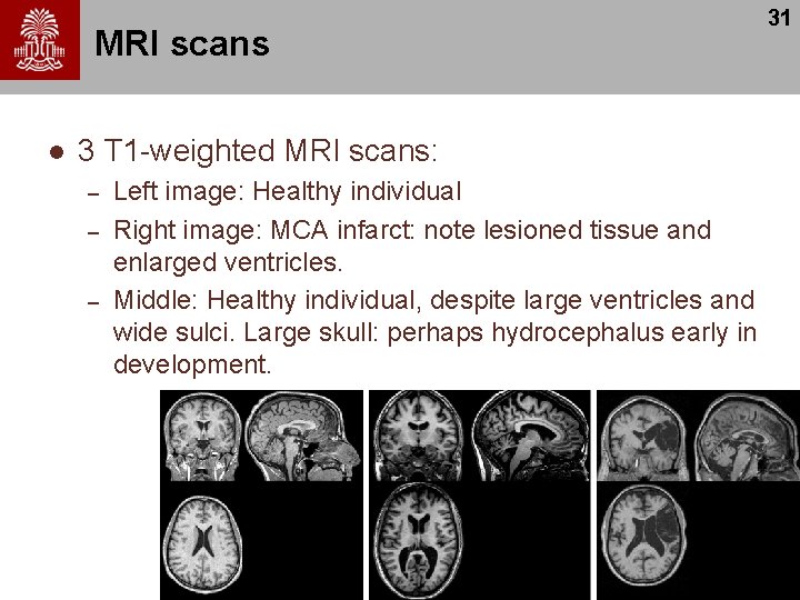 MRI scans l 3 T 1 -weighted MRI scans: – – – Left image: