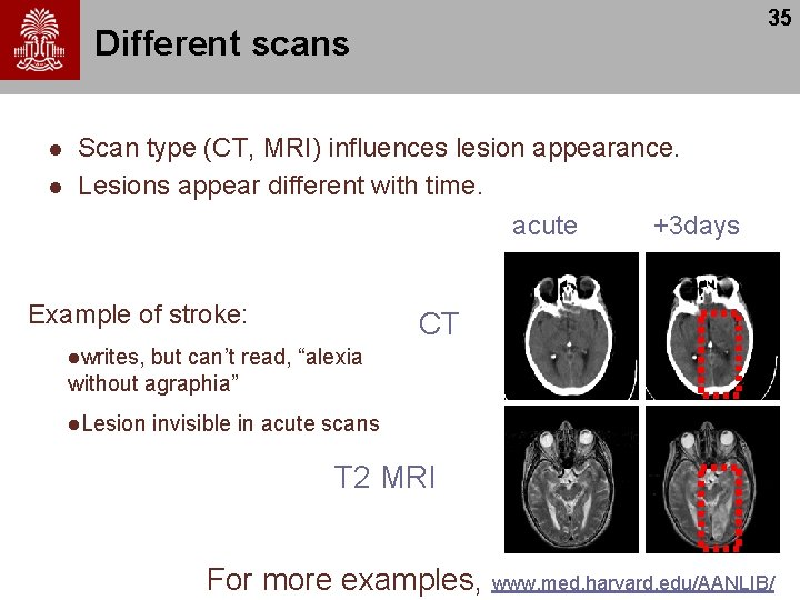 35 Different scans l l Scan type (CT, MRI) influences lesion appearance. Lesions appear