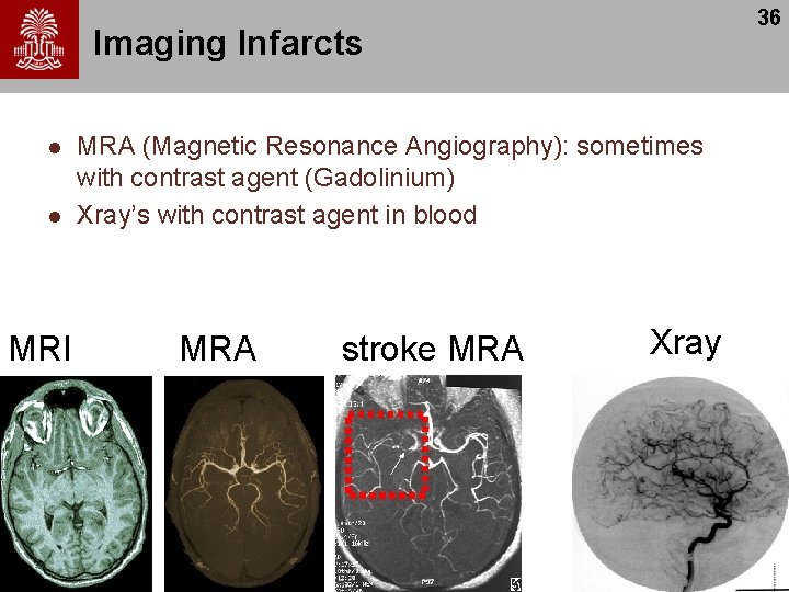 36 Imaging Infarcts l l MRI MRA (Magnetic Resonance Angiography): sometimes with contrast agent