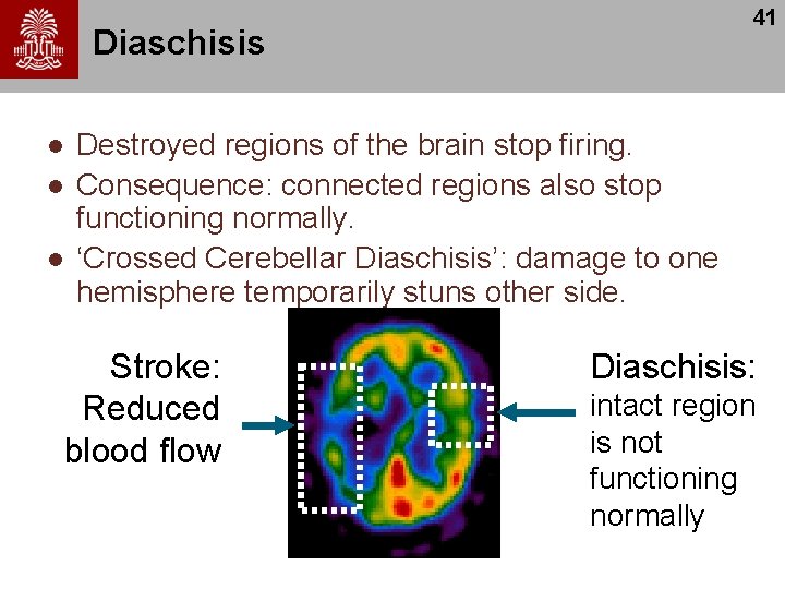 41 Diaschisis l l l Destroyed regions of the brain stop firing. Consequence: connected