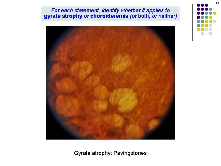 18 For each statement, identify whether it applies to gyrate atrophy or choroideremia (or 18 For each statement, identify whether it applies to gyrate atrophy or choroideremia (or