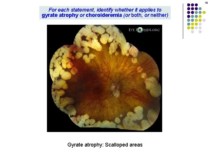 19 For each statement, identify whether it applies to gyrate atrophy or choroideremia (or 19 For each statement, identify whether it applies to gyrate atrophy or choroideremia (or