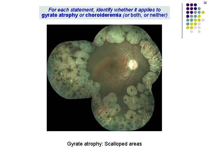 20 For each statement, identify whether it applies to gyrate atrophy or choroideremia (or 20 For each statement, identify whether it applies to gyrate atrophy or choroideremia (or