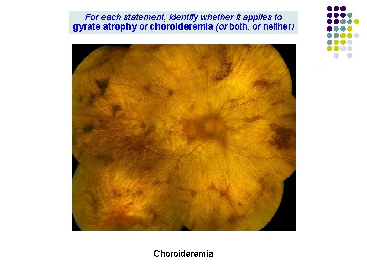 For each statement, identify whether it applies to gyrate atrophy or choroideremia (or both, For each statement, identify whether it applies to gyrate atrophy or choroideremia (or both,