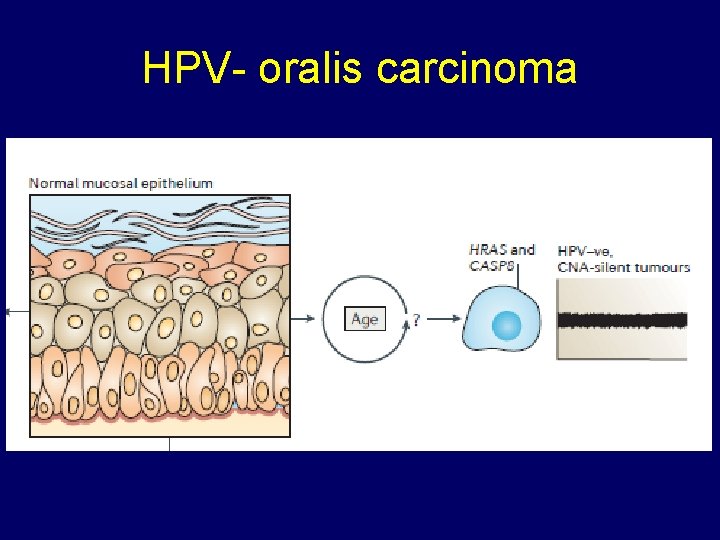 HPV- oralis carcinoma 