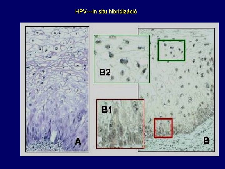 HPV---in situ hibridizáció 