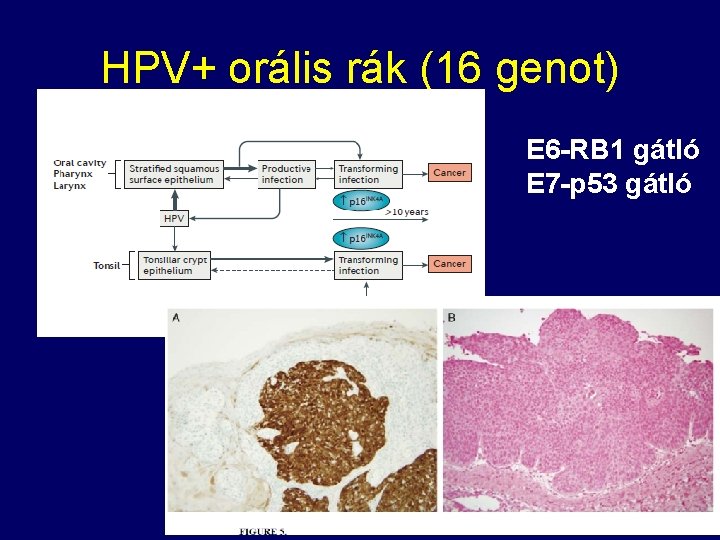 HPV+ orális rák (16 genot) E 6 -RB 1 gátló E 7 -p 53