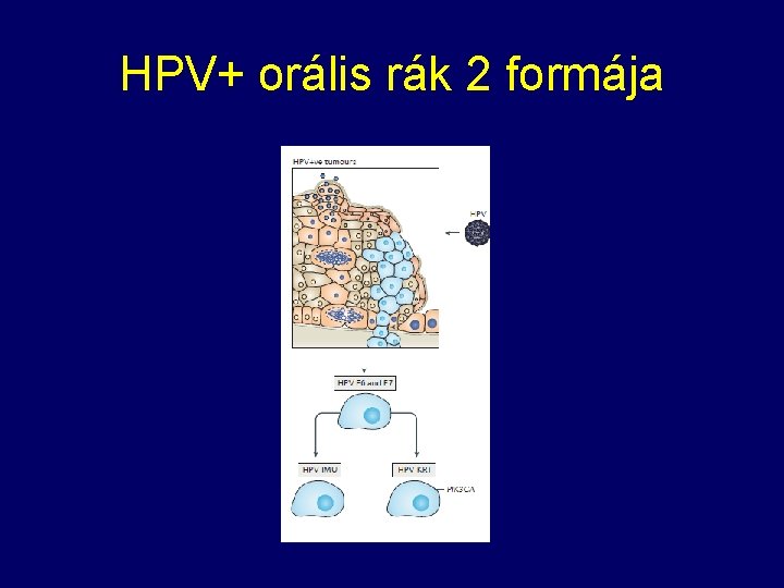 HPV+ orális rák 2 formája 