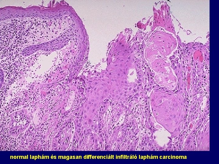 normal laphám és magasan differenciált infiltráló laphám carcinoma 