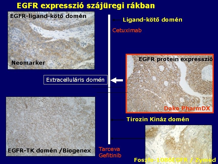 EGFR expresszió szájüregi rákban EGFR-ligand-kötő domén Ligand-kötő domén Cetuximab EGFR protein expresszió Neomarker Extracelluláris