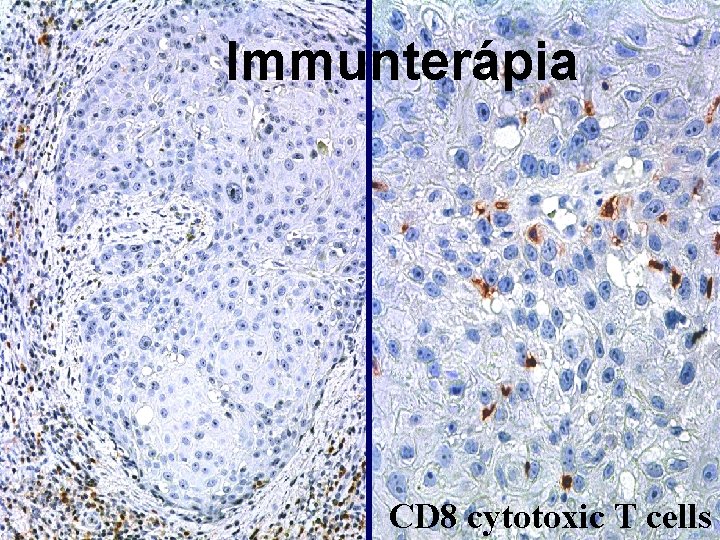 Immunterápia CD 8 cytotoxic T cells 