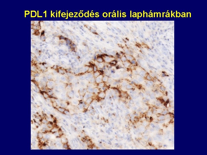 PDL 1 kifejeződés orális laphámrákban 