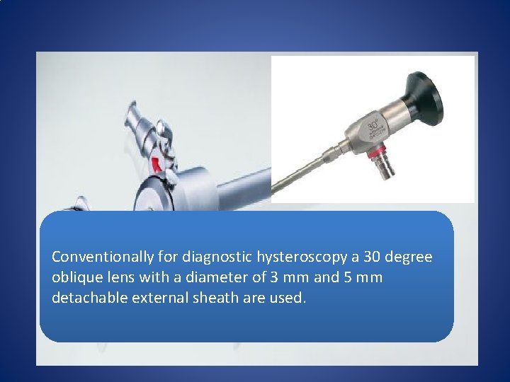 Conventionally for diagnostic hysteroscopy a 30 degree oblique lens with a diameter of 3
