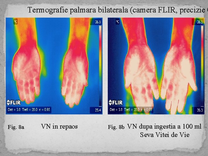 Termografie palmara bilaterala (camera FLIR, precizie 0 Fig. 8 a VN in repaos Fig.
