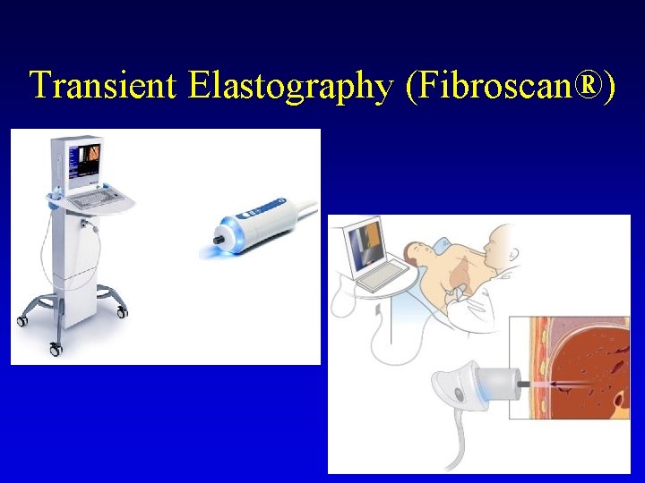 Transient Elastography (Fibroscan®) Transient Elastography (Fibroscan®)
