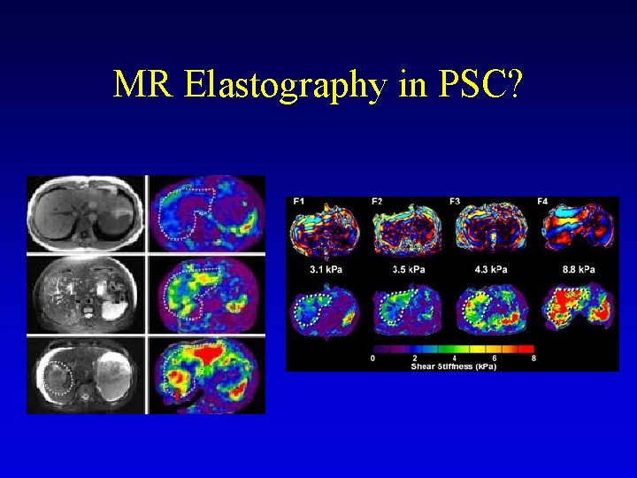 MR Elastography in PSC? MR Elastography in PSC?