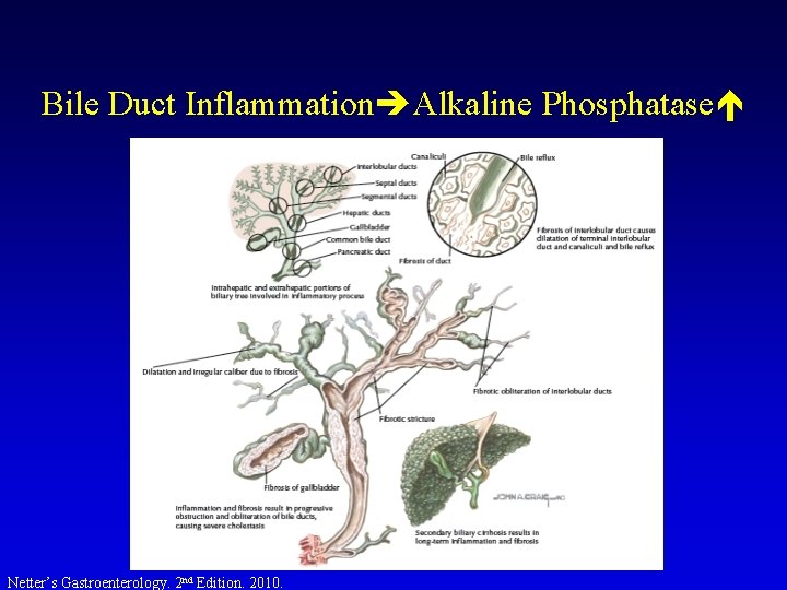 Bile Duct Inflammation Alkaline Phosphatase Netter’s Gastroenterology. 2 nd Edition. 2010. Bile Duct Inflammation Alkaline Phosphatase Netter’s Gastroenterology. 2 nd Edition. 2010.
