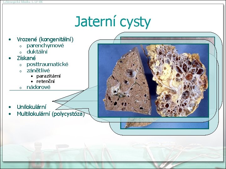 Jaterní cysty • Vrozené (kongenitální) o o • parenchymové duktální Získané o o posttraumatické