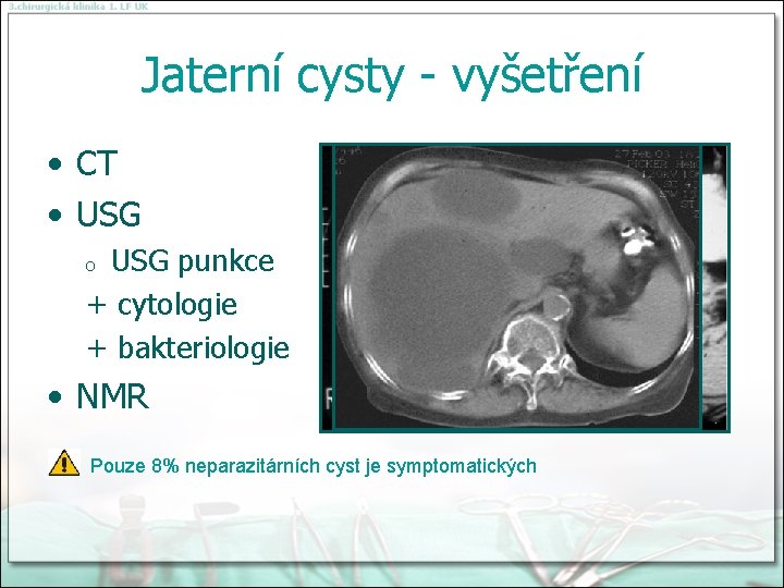 Jaterní cysty - vyšetření • CT • USG punkce + cytologie + bakteriologie o
