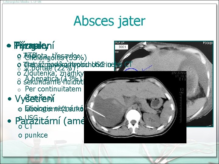 Absces jater Terapie • Příznaky Pyogenní • • ATB oo Teplota, třesavky Cholangoitis (33%)