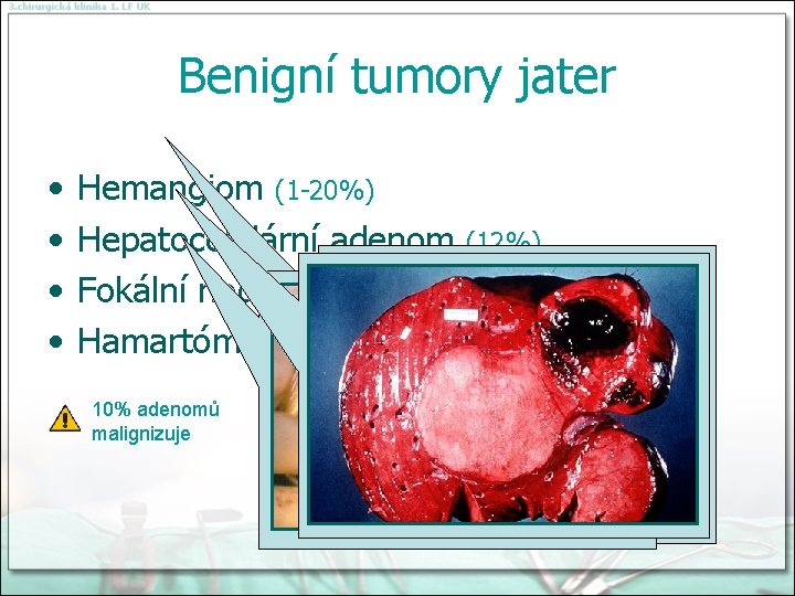 Benigní tumory jater • • Hemangiom (1 -20%) Hepatocelulární adenom (12%) Fokální nodulární hyperplázie