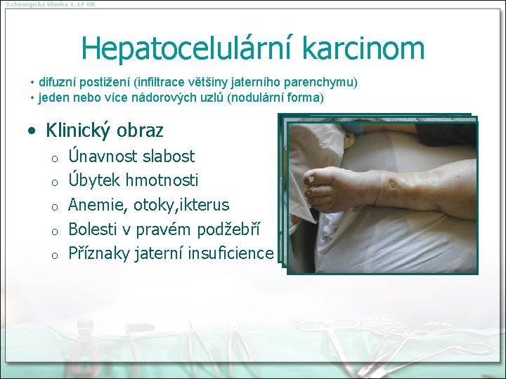 Hepatocelulární karcinom • difuzní postižení (infiltrace většiny jaterního parenchymu) • jeden nebo více nádorových