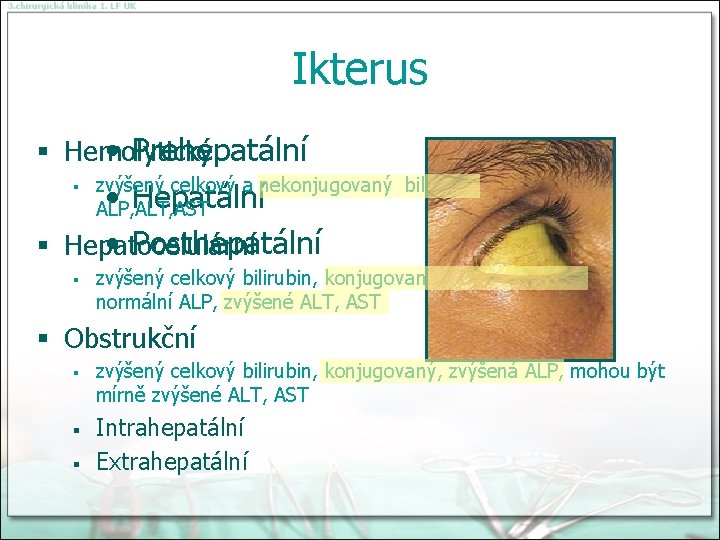 Ikterus • Prehepatální § Hemolytický zvýšený celkový a nekonjugovaný bilirubin, normální ALP, ALT, AST