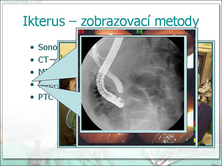 Ikterus – zobrazovací metody • • • Sonografie CT MRI ERCP PTC 