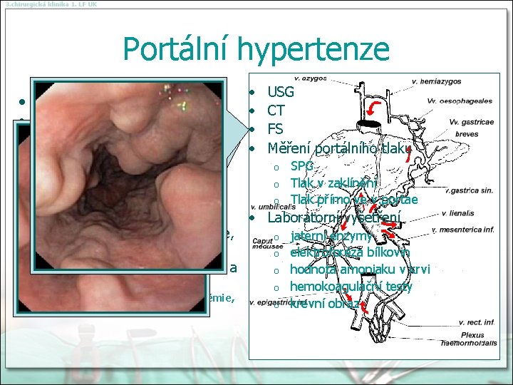 Portální hypertenze • • • • • USG CT FS Měření portálního tlaku Dyspepsie