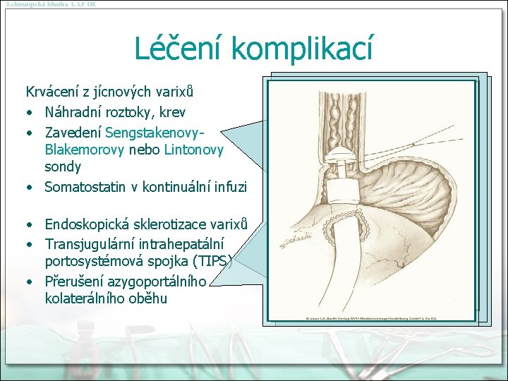 Léčení komplikací Krvácení z jícnových varixů • Náhradní roztoky, krev • Zavedení Sengstakenovy. Blakemorovy