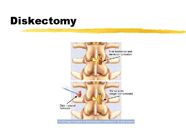 Diskectomy 