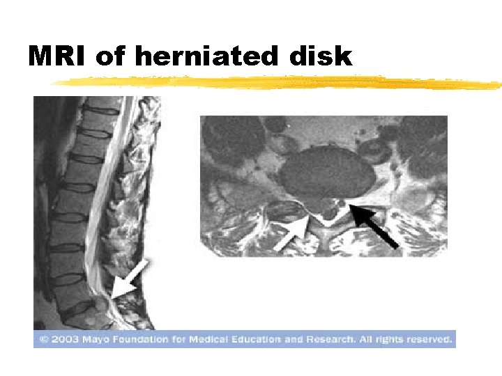 MRI of herniated disk 