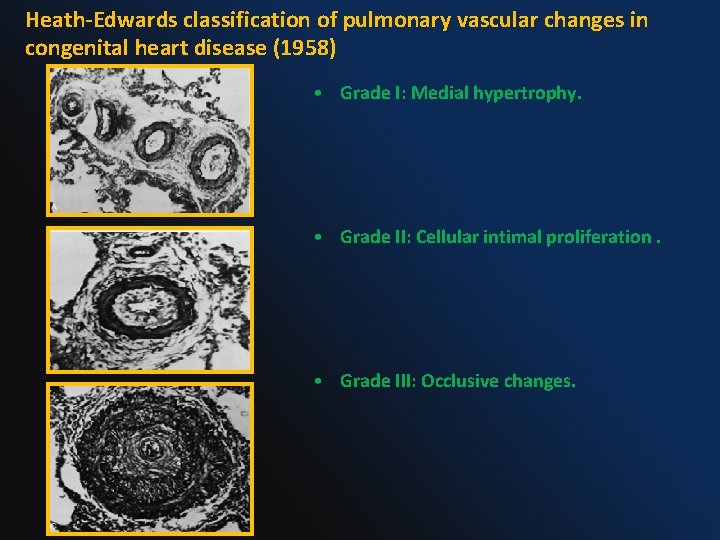 Heath-Edwards classification of pulmonary vascular changes in congenital heart disease (1958) • Grade I:
