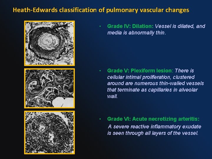 Heath-Edwards classification of pulmonary vascular changes • Grade IV: Dilation: Vessel is dilated, and