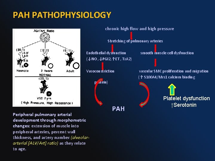  PAH PATHOPHYSIOLOGY chronic high flow and high pressure Stretching of pulmonary arteries Endothelial