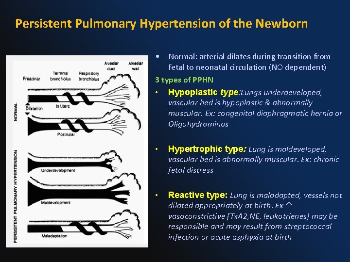 Persistent Pulmonary Hypertension of the Newborn • Normal: arterial dilates during transition from fetal