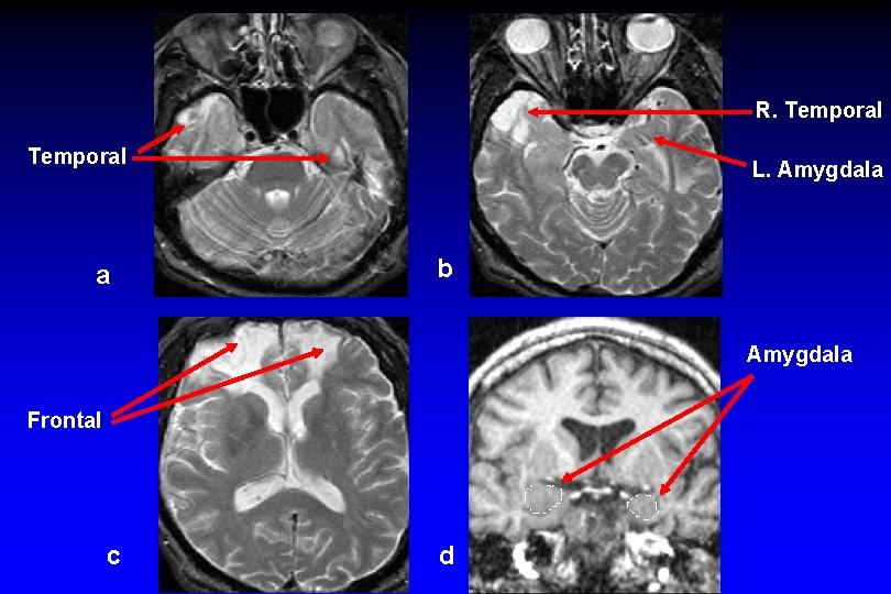 R. Temporal a L. Amygdala b Amygdala Frontal c d 