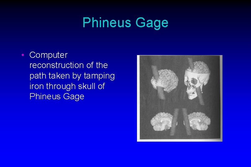Phineus Gage • Computer reconstruction of the path taken by tamping iron through skull